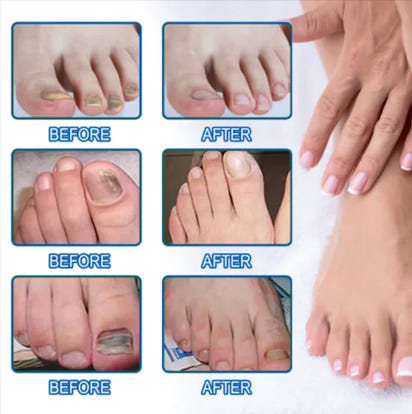 Clear Nail™ - Fungal Nail Renewal Patches