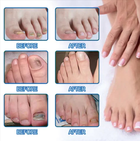 Clear Nail™ - Fungal Nail Renewal Patches