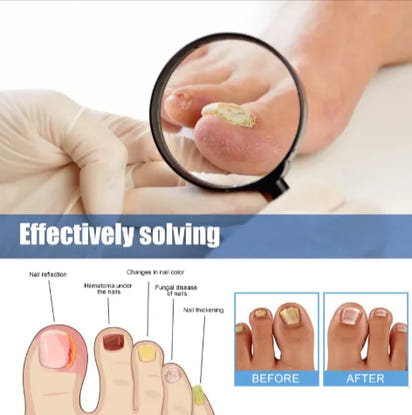 Clear Nail™ - Fungal Nail Renewal Patches